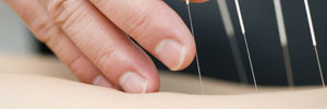 Gunn Intramuscular Stimulation-IMS (Dry Needling)